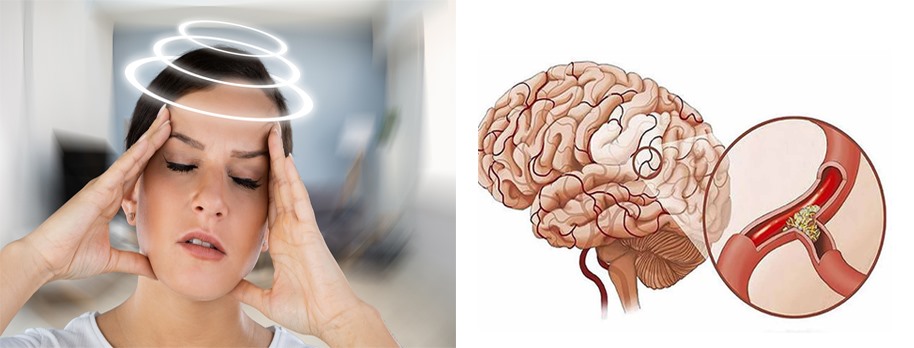 Đừng nhầm lẫn giữa rối loạn tiền đình và thiếu máu não!